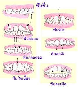 ปัญหาฟันรูปแบบต่างๆ